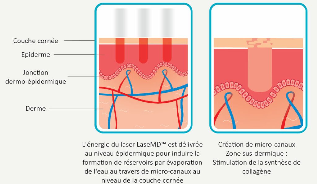 Le fonctionnement du laser MD à Tarbes chez le Dr Assouere